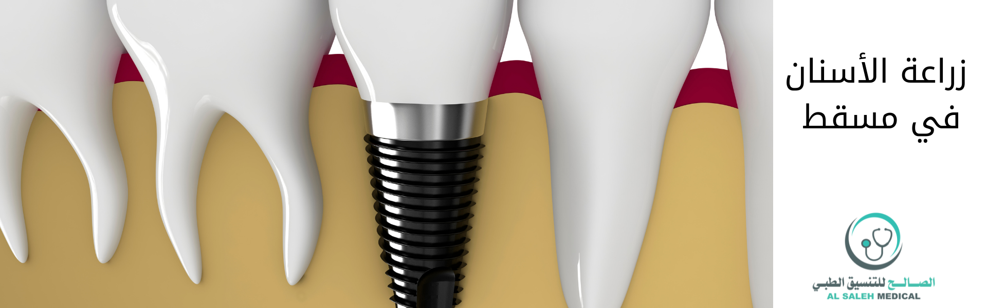 أسعار زراعة الأسنان في مسقط| عروض خاصة في موقعنا - عيادات مسقط